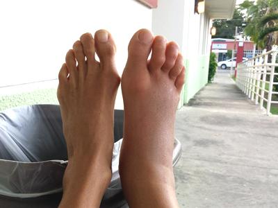 Gina Bradley's foot swelled after a stonefish stung her in Puerto Rico.