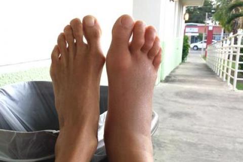 Gina Bradley's foot swelled after a stonefish stung her in Puerto Rico.